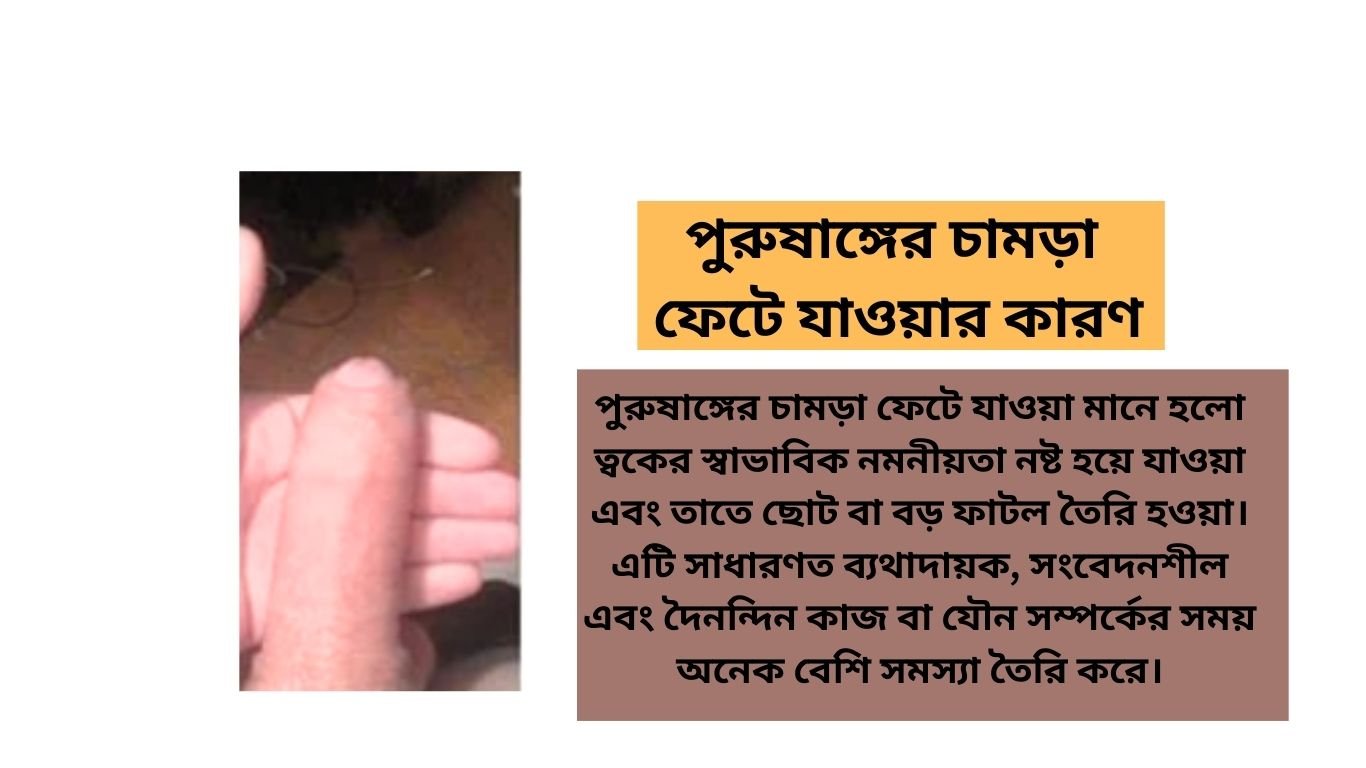 পুরুষাঙ্গের চামড়া ফেটে যাওয়ার কারণ