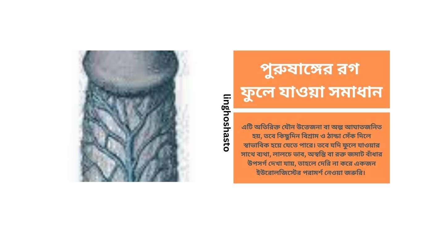 পুরুষাঙ্গের রগ ফুলে যাওয়া সমাধান